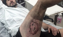 Bỏng nặng vì iPhone 6 phát nổ trong túi quần