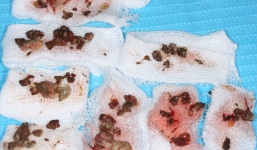 Gắp dị vật trong xoang hàm bệnh nhân từng nhổ răng