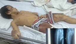 Bố mẹ đánh con trai 5 tuổi gãy chân