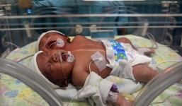 Kỳ lạ bé gái hai đầu chào đời ở Indonesia