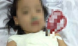 Cứu sống bé gái 5 tuổi bị kéo đâm xuyên ngực