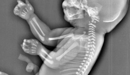 Mẹ hủy thai khi siêu âm thấy con có hình dạng 'nàng tiên cá'