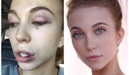 Thí sinh Hoa hậu Hoàn vũ bị đánh hội đồng trong nhà vệ sinh