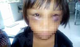 Bé gái 7 tuổi nghi bị mẹ kế đánh sưng mắt, châm thuốc lá bỏng tay