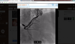 Lấy thành công dị vật 45 năm trong tim phụ nữ ở Bến Tre