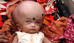 Xót xa bé 4 tháng tuổi bị cha mẹ bỏ rơi vì đầu to gấp 3 bình thường