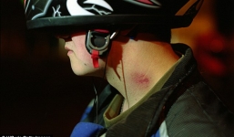 Thiếu niên 17 tuổi tử vong vì bị hôn vào cổ