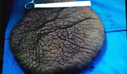 Tách khối bướu 'mai rùa' nặng 1 kg khỏi lưng bé gái 10 tuổi