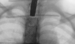 Bé gái bị thủng thực quản do nuốt đồ chơi