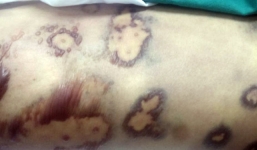 Bệnh nhân mắc bệnh lạ sau khi ăn tiết canh vịt đã tử vong