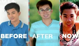 Trai đẹp ân hận cả đời vì nâng mũi với giá 10 USD