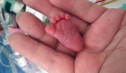 Hy hữu bé sơ sinh 'tí hon' chỉ nặng hơn 226g vẫn sống sót kỳ diệu