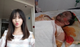 Tai nạn giao thông, nữ sinh xinh đẹp bị bỏng toàn thân