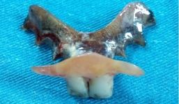 Hy hữu: Cụ ông nuốt cả hàm răng giả có móc sắc nhọn khi... ăn sáng