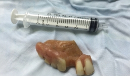 Cụ ông nhập viện cấp cứu vì nuốt hàm răng giả