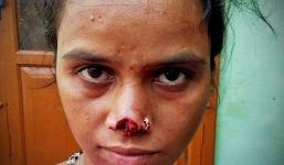 Chồng cắt mũi vợ vì không lấy đủ tiền hồi môn