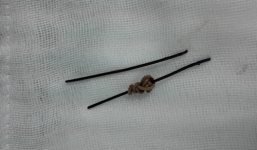 Phẫu thuật lấy dây kẽm dài 8cm trong bụng người đàn ông 