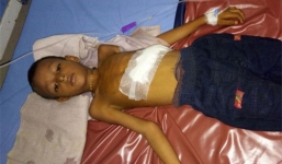 Hy hữu bào thai song sinh trong bụng bé trai 6 tuổi