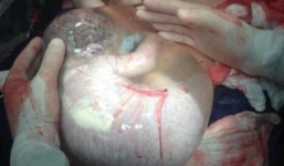 Video em bé sinh mổ nằm nguyên trong bọc ối 80.000 ca có một