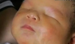 Hy hữu bé trai mắc bệnh kỳ lạ khi sinh ra không có mắt