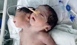 Bé trai hai đầu tử vong sau khi được sinh ra