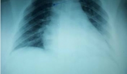 Cứu thành công sản phụ song sinh bị tai biến sản khoa