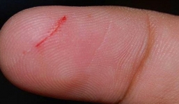 Tử vong chỉ sau 5 ngày vì vết xước nhỏ