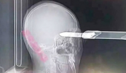 Người đàn ông sống sót bất ngờ sau khi bị dao găm vào đầu