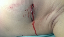 Nguy kịch vì bị kim loại cắm sâu vào ngực khi đang đi trên đường