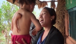 Kỳ lạ cậu bé 2 tuổi 'mọc' thêm tay ở lưng