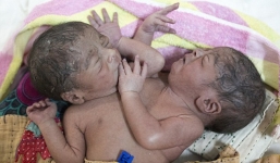 Xót xa cảnh song sinh dính liền bị bỏ rơi khi mới chào đời