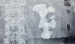 Hy hữu 4 lần phẫu thuật lấy sỏi thận lớn kỷ lục