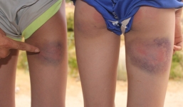 Thầy giáo 'trần tình' vụ 6 học sinh bị đánh bầm tím đùi