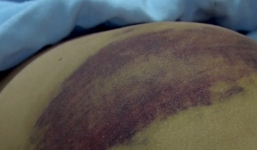 Bé trai 12 tuổi nghi bị mẹ kế dùng chày đập đá hành hạ 