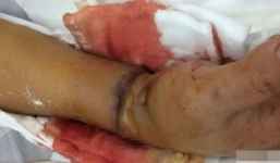 Không đồng ý ly hôn, chồng chém đứt lìa tay vợ trước sân tòa