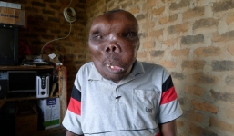 Người đàn ông 'mặt quỷ' lấy được vợ 2 và trở thành ngôi sao ca nhạc