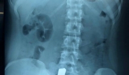 Nữ sinh 16 tuổi bị thanh sắt trên xe ba gác đâm xuyên người