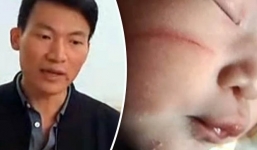 Bác sĩ làm rách mặt bé sơ sinh khi đẻ mổ