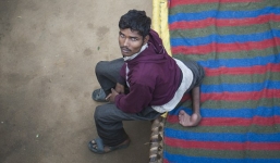 'Dị nhân' 22 tuổi khổ sở vì có chân mọc ở lưng