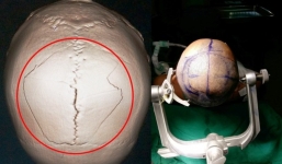 Nứt sọ, tụ máu não sau 2 ngày bị đụng đầu trần nhà