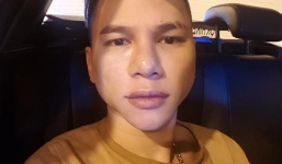 Khuôn mặt Hoàng Tôn 'biến dạng' vì phẫu thuật hỏng