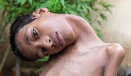 Cậu bé đầu nghiêng 180 độ tử vong sau 8 tháng phẫu thuật