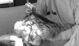 Bóc tách thành công khối u buồng trứng 'khủng' nặng 35kg
