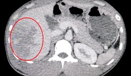 Cứu thành công bệnh nhân vỡ gan vì bánh xe tải bất ngờ phát nổ