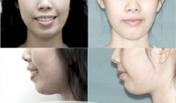 Tại sao các cách chữa hô răng tại nhà không đạt được kết quả như ý?