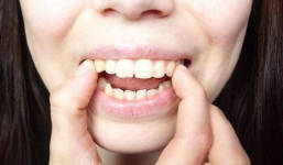 Gợi ý mẹo chữa răng hô thực hiện tại nhà đơn giản, an toàn