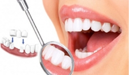 Bật mí cho các nàng 3 mẹo trị hô răng đơn giản và hiệu quả tại nhà