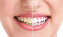 Cách làm trắng răng với bột nghệ an toàn và hiệu quả