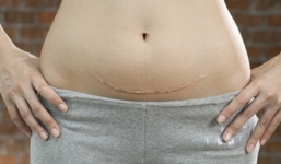 Mách chị em cách làm đẹp da sau sinh mổ hiệu quả nhất