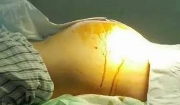 Hy hữu bé gái 12 tuổi mắc ung thư buồng trứng